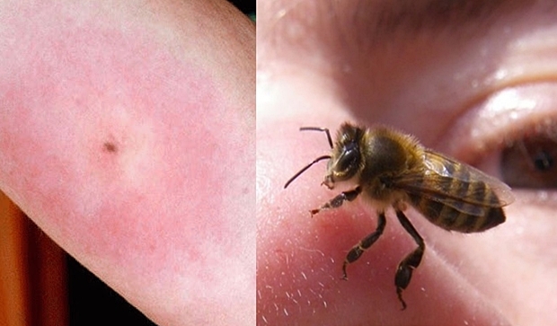 Kada vas ubode osa, pčela ili stršljen – ovo će vas spasiti BOLA i OTOKA